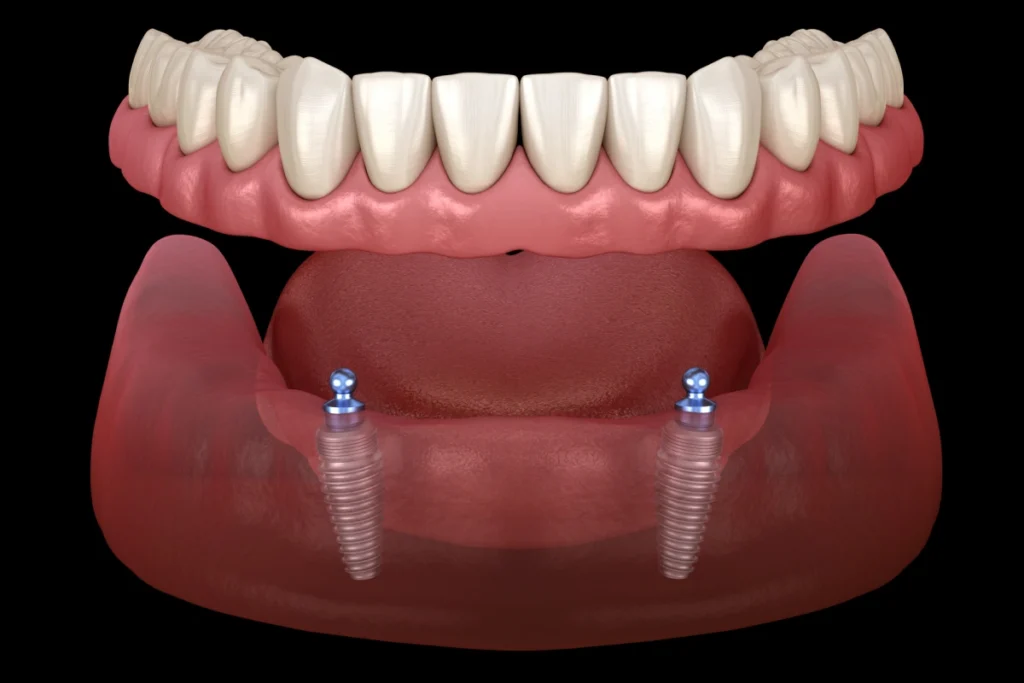 All-on-4 implant supported denture diagram showing four titanium implants anchoring a full arch prosthetic