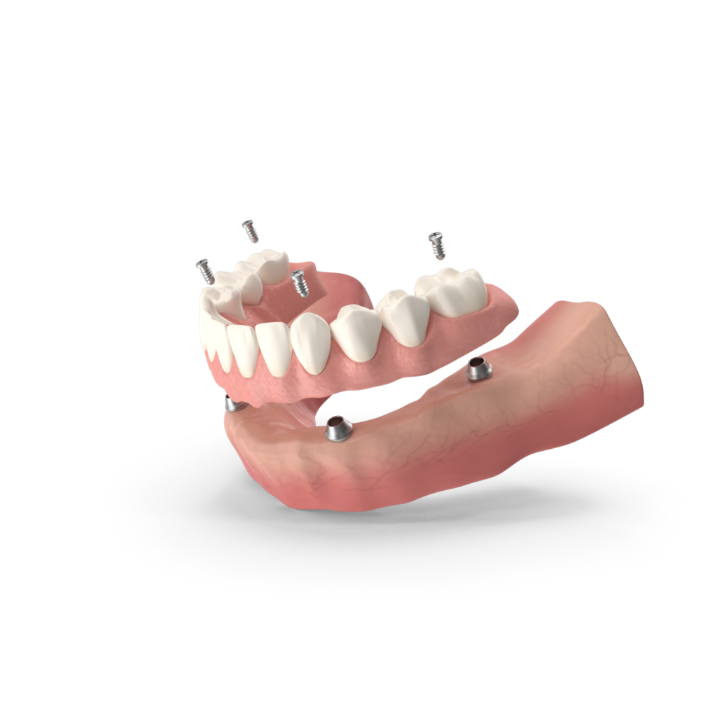 All-on-4 implant supported denture diagram showing four titanium implants anchoring a full arch prosthetic