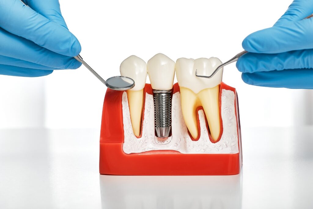 dental implants great neck - Immediate Implant Placement