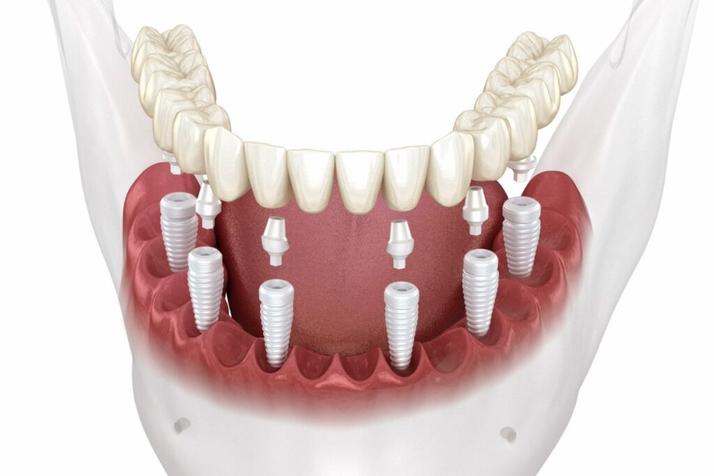 All-on-4 Implants