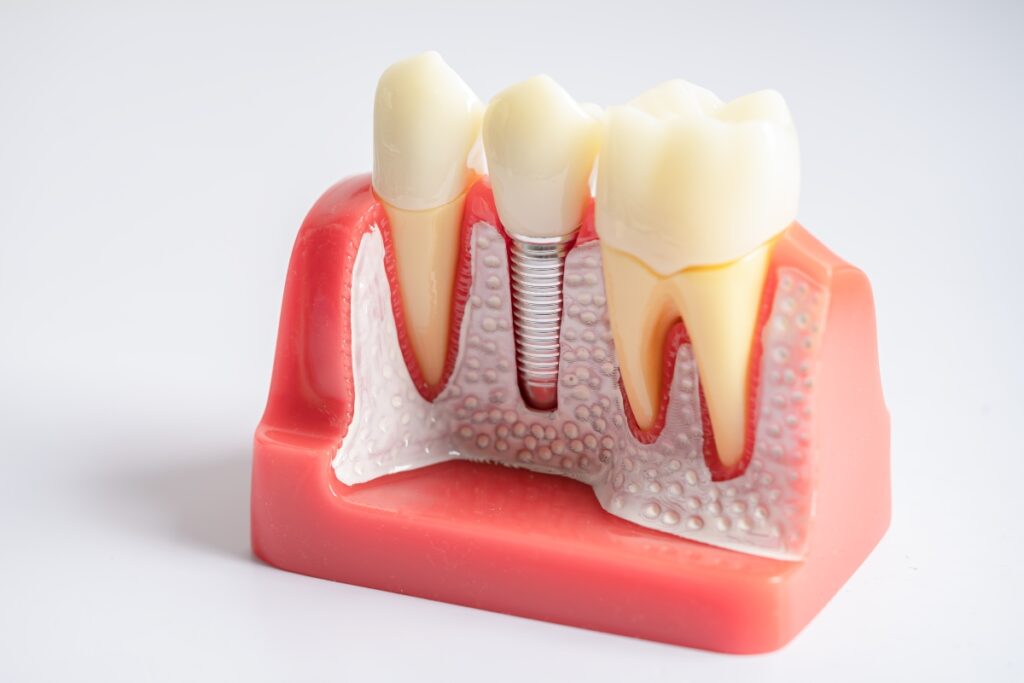 Dental implant model showing abutment and crown placement in jawbone for Great Neck patients.