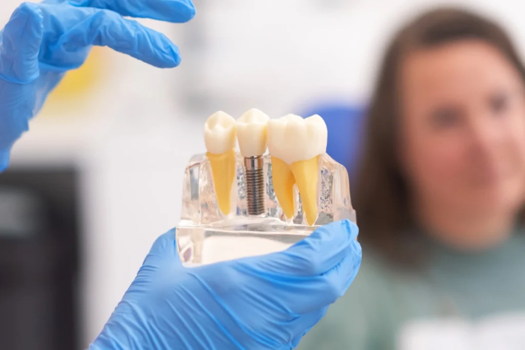 Dental implant model showing natural tooth, titanium screw, and crown restoration.