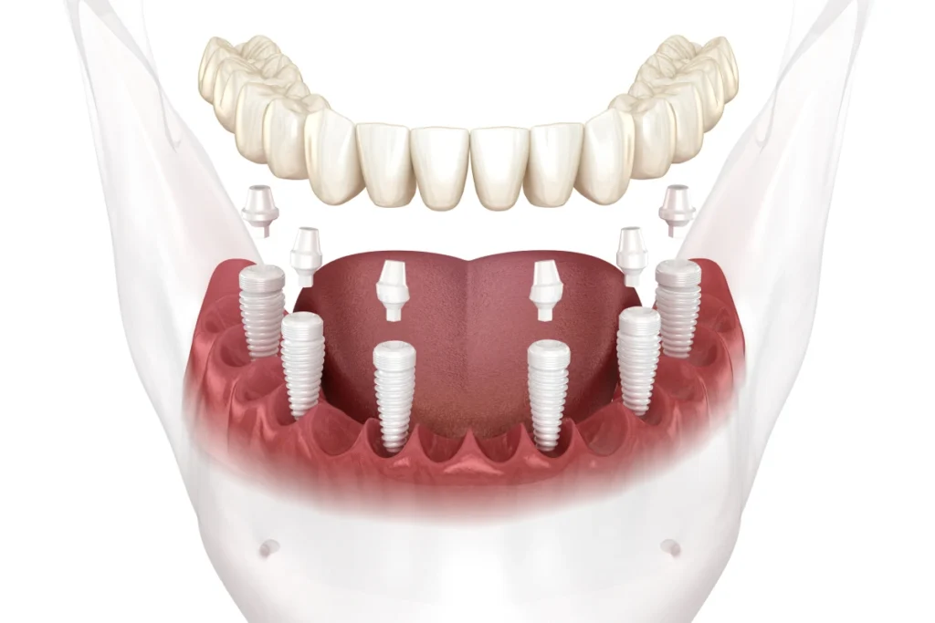 All-on-4 dental implants diagram showing four implants supporting a full arch of replacement teeth.