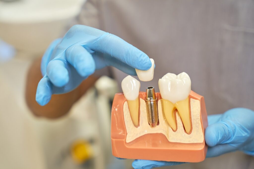 Dental Implants vs. Existing Restorations